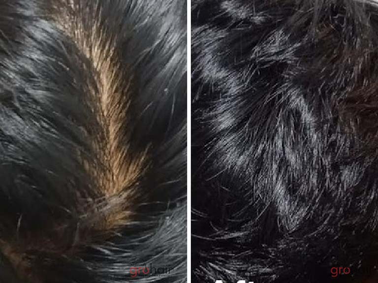 hair fall treatment in chennai