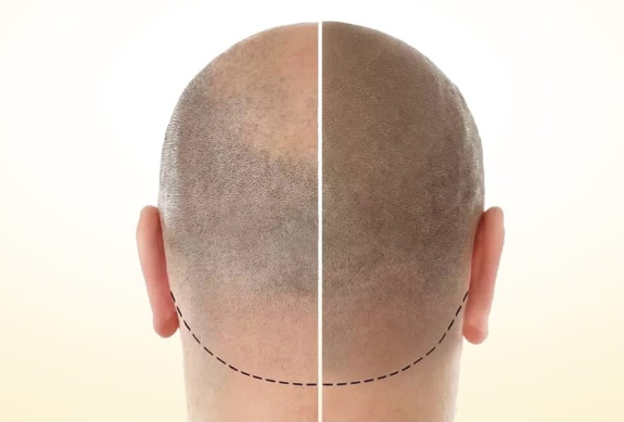 micropigmentation of scalp