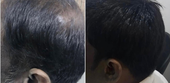 hair treatment chennai